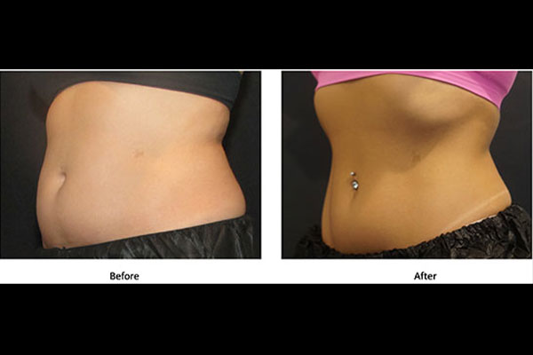 before and after CoolSculpting in Santa Clarita