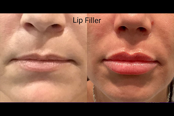 before and after lip flip in Santa Clarita