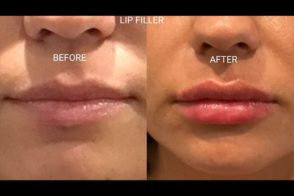 before and after lip filler in Valencia