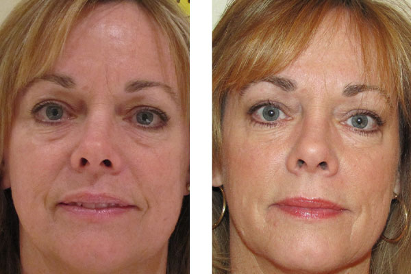 woman before and after Restylane in Santa Clarita
