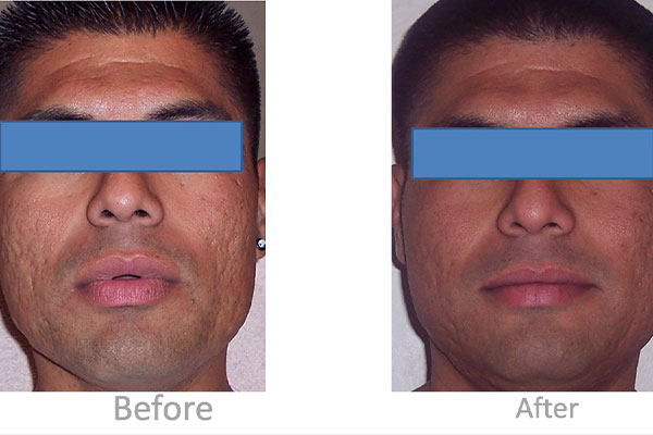 Before and after laser skin resurfacing in Valencia.