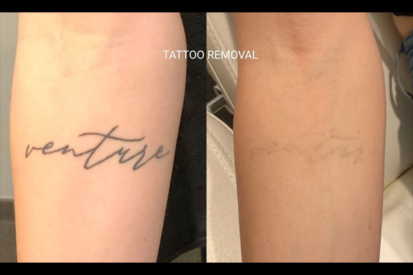 before and after laser tattoo removal in Valencia