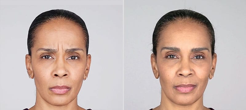 patient before and after Botox